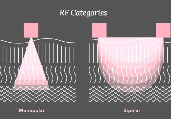 Radio Frequency Skin Tightening
